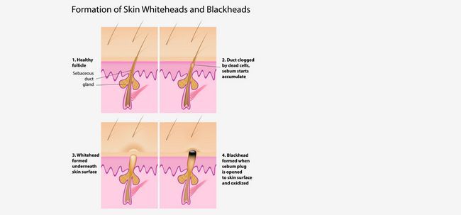Points noirs et blancs: Début de l'acné