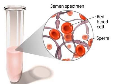 Sang dans le sperme - Causes, symptômes et traitement