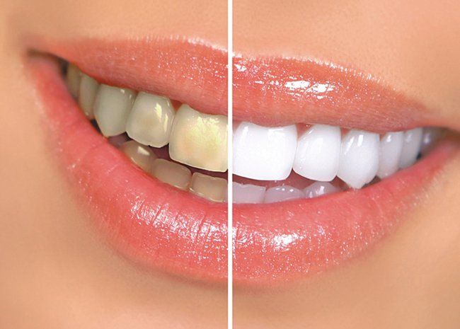 Causes des dents et des conseils de prévention jaunes pour les dents jaunes