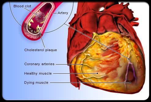 maladies cardiaques