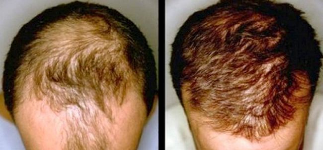 La croissance des cheveux contre la calvitie - Causes et solutions