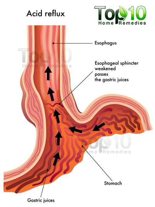 Reflux acide diagramme