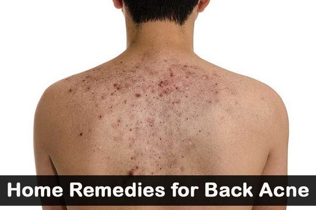 Remèdes à la maison pour l'acné de retour