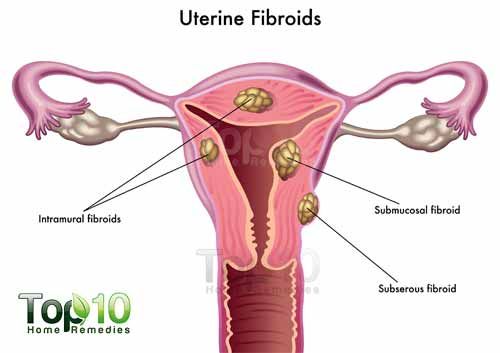 utérins fibromes-500-