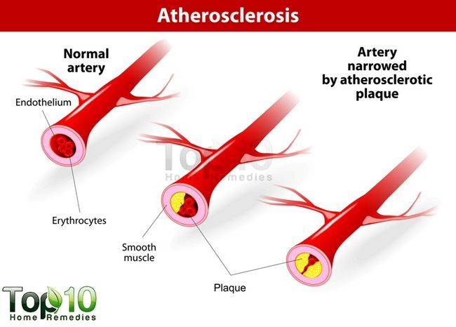 les maladies du cœur de l'athérosclérose