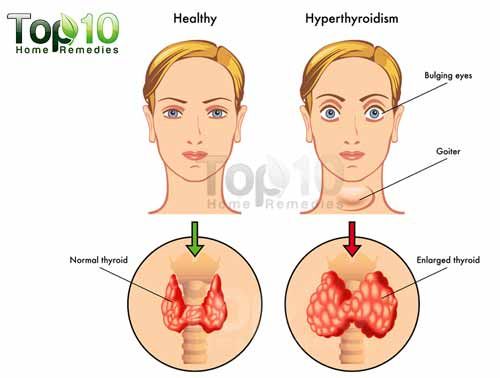 Schéma de l'hyperthyroïdie