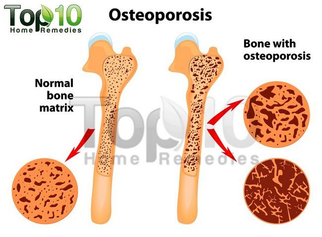 Ostéoporose illustration