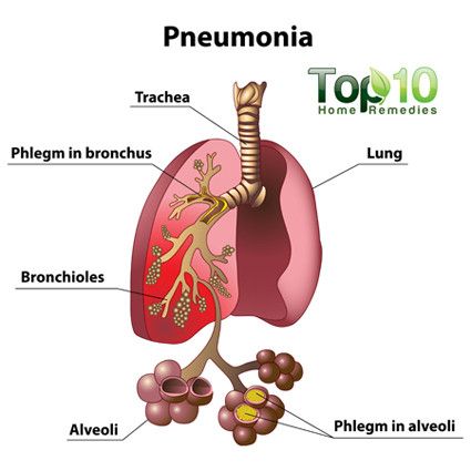 Pneumonie schéma médicale