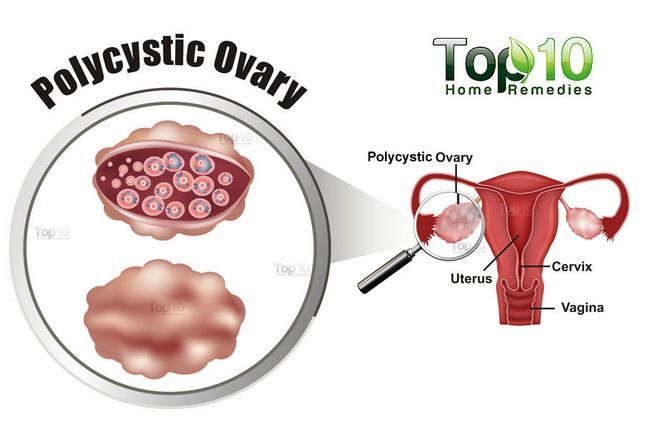 diagramme des ovaires polykystiques