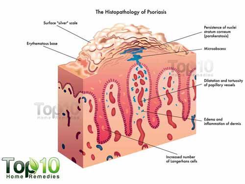 diagramme de psoriasis