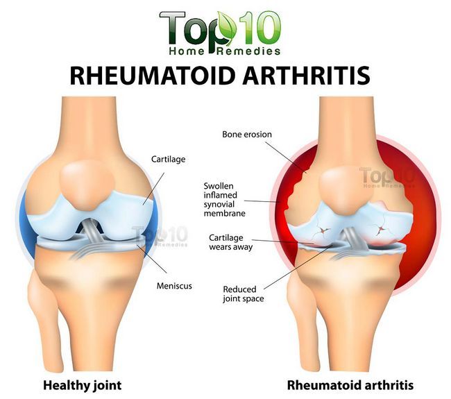 Arthrite rhumatoïde diagramme de