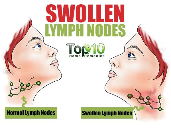 Normale vs. Swollen ganglions lymphatiques
