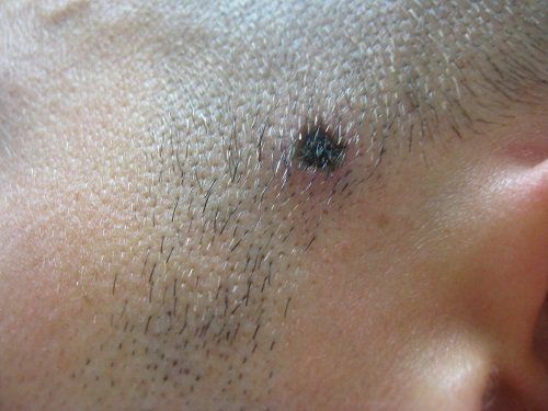 naturelles-façons à enlever à la naissance marques