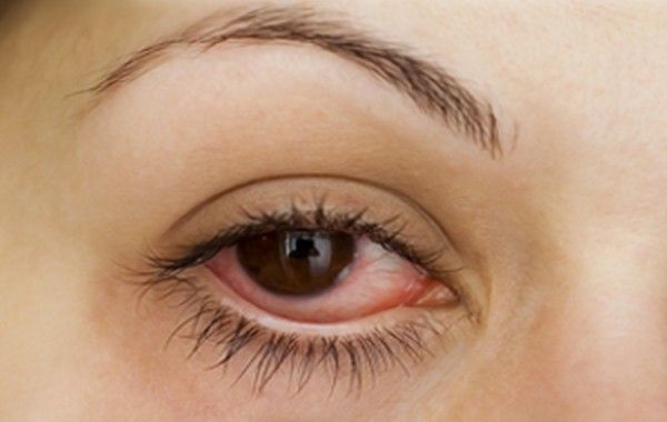 Accueil remèdes pour traiter les démangeaisons des yeux