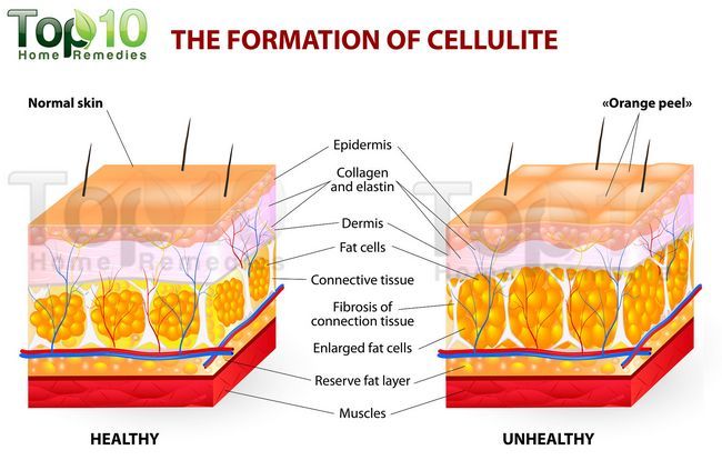 diagramme de la cellulite