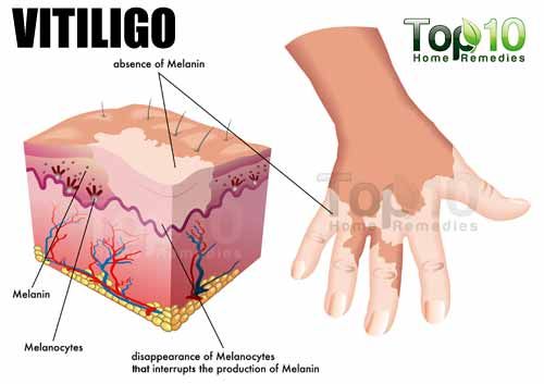 vitiligo illustration