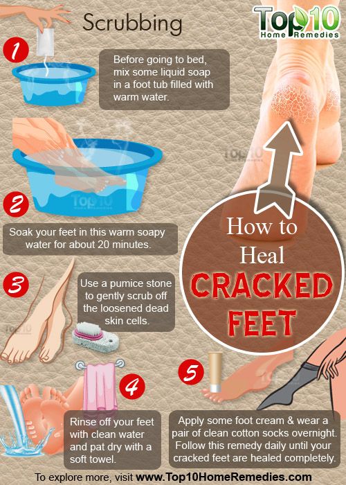 comment guérir fissures pieds
