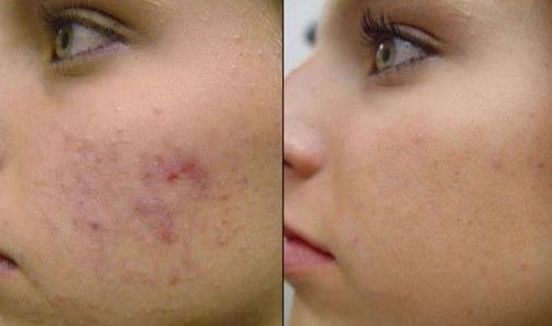 Comment traiter les formes les plus graves de l'acné
