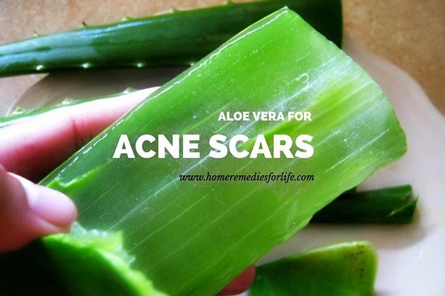 L'aloe vera Pour les cicatrices d'acné