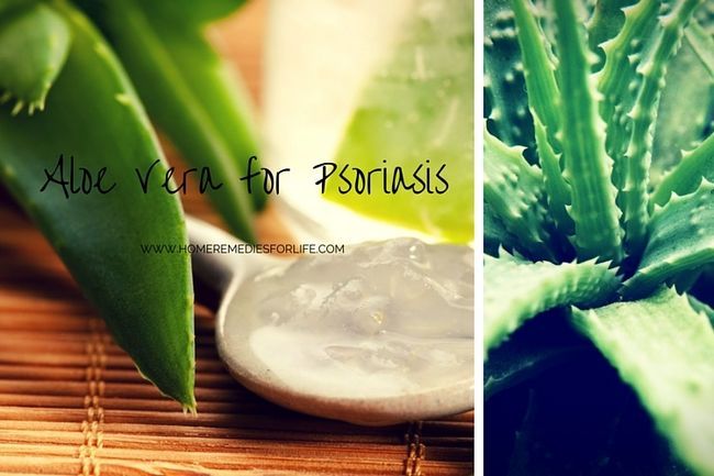 Aloe vera pour le psoriasis