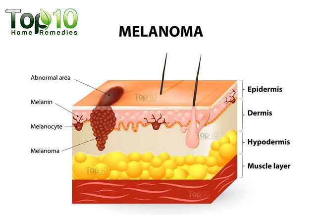 Cancer du mélanome de la peau