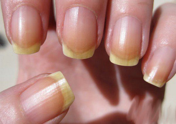 Raisons de décoloration des ongles - remèdes pour décoloration des ongles