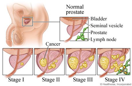 Les symptômes de cancer de la prostate - Comment connaître et reconnaître?