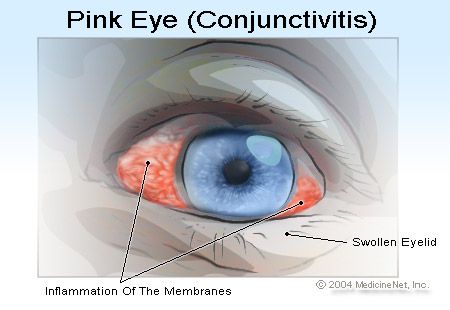 Conseils pour éviter de propager les yeux roses / conjonctivite