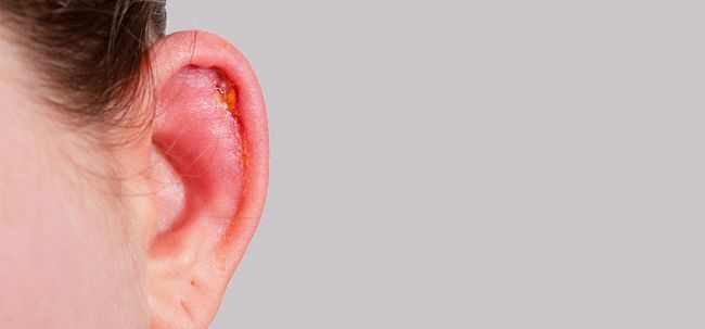 Top 10 efficace Accueil recours pour les infections de l'oreille