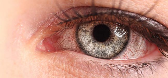 Top 10 des remèdes maison pour obtenir un soulagement de Pink Eye