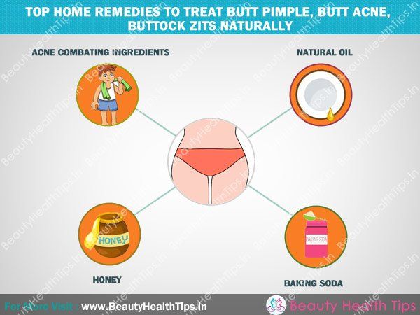 Top-home-remèdes à traiter-fesses-Pimple, -butt-acné, -buttock-acné naturellement
