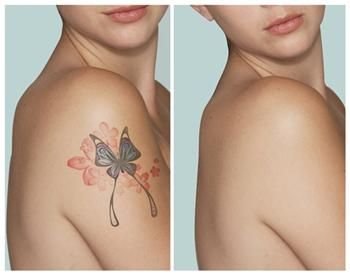 Méthodes d'enlèvement Haut de tatouages
