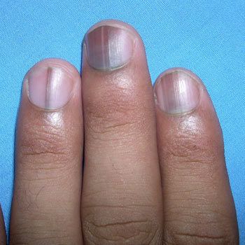 Quels sont les effets des carences nutritives sur les ongles et comment y remédier?