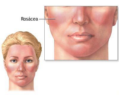 Quel est l'acné rosacée? Accueil recours pour l'acné adulte