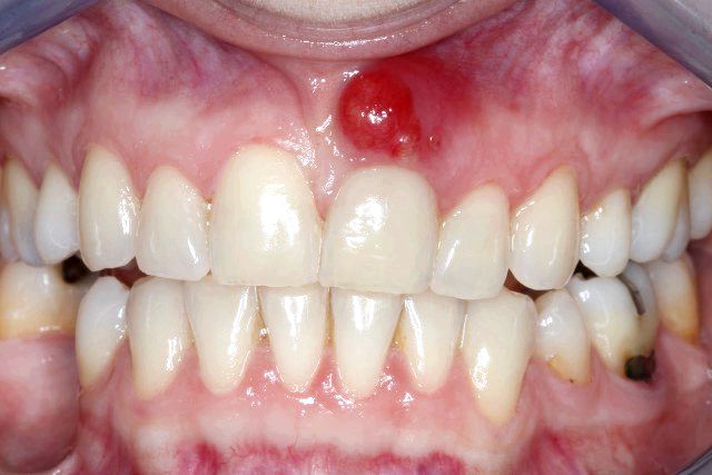 11 Accueil recours pour abcès dentaire