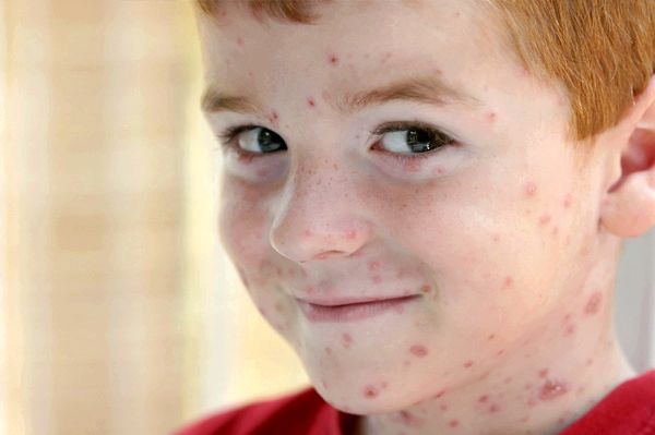 19 remèdes maison pour guérir la varicelle