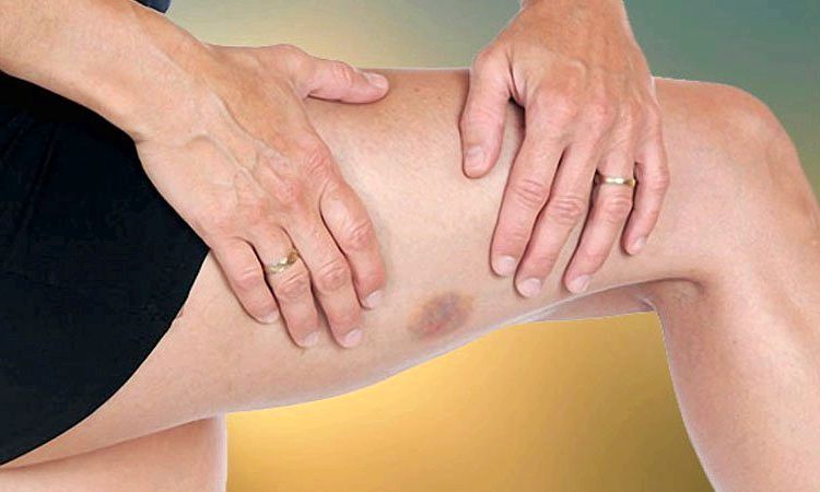 20 Accueil recours pour Bruises