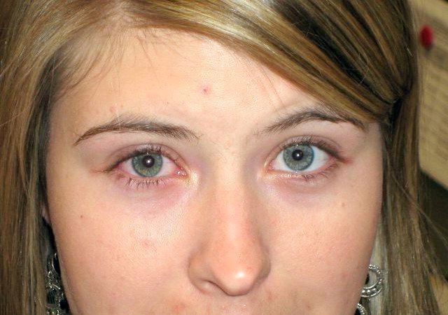 26 Home Remedies pour Pink Eye Relief