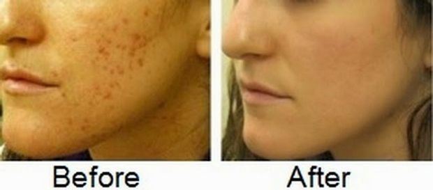 Top 11 remèdes pour éliminer les cicatrices d'acné