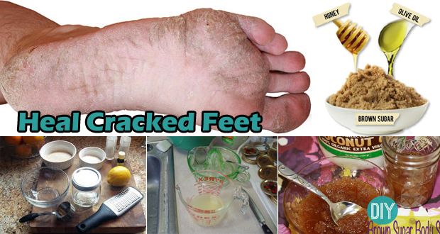 12 étonnantes façons de guérir pieds crevassés