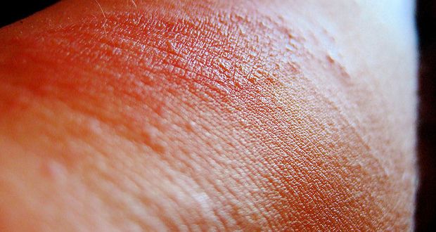 Remèdes pour Poison Oak