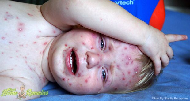 18 simples remèdes maison pour la varicelle