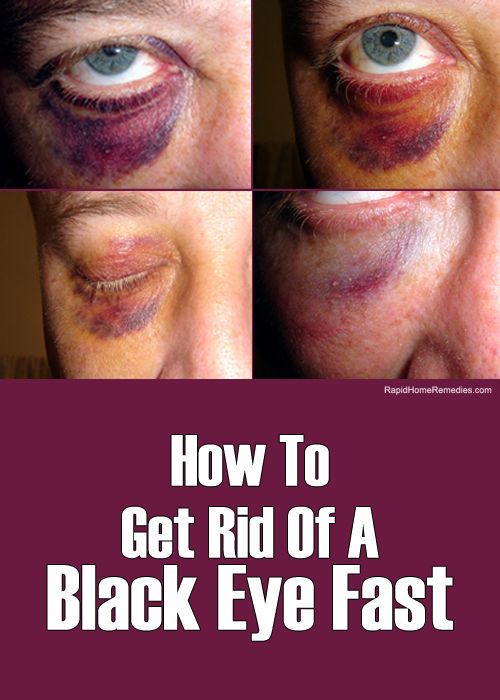 Façons simples de se débarrasser de Black Eye