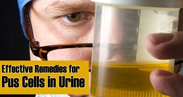 15 remèdes efficaces à domicile pour les cellules de pus dans les urines