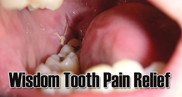 15 Accueil recours pour la sagesse instantanée soulagement de la douleur de la dent