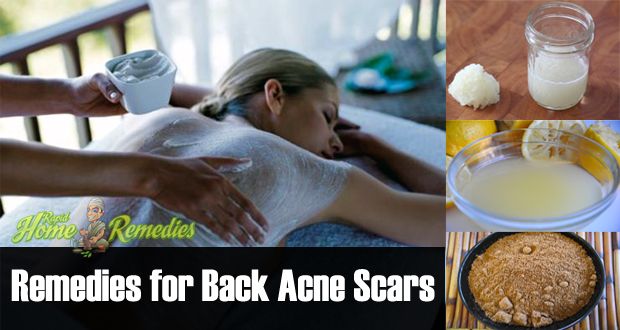 15 Les remèdes naturels pour se débarrasser des cicatrices d'acné dos
