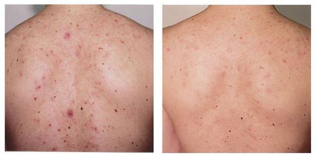 Débarrassez-vous de l'acné de retour avec 15 meilleurs remèdes à la maison