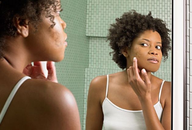 traiter l'acné sur le hypehair spot
