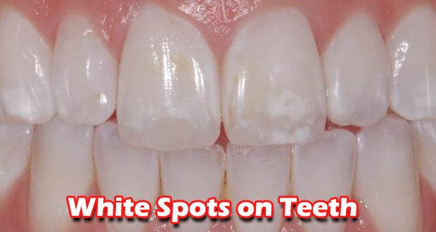 Comment se débarrasser des taches blanches sur les dents rapides