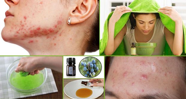 Remèdes naturels pour se débarrasser de l'acné kystique rapide